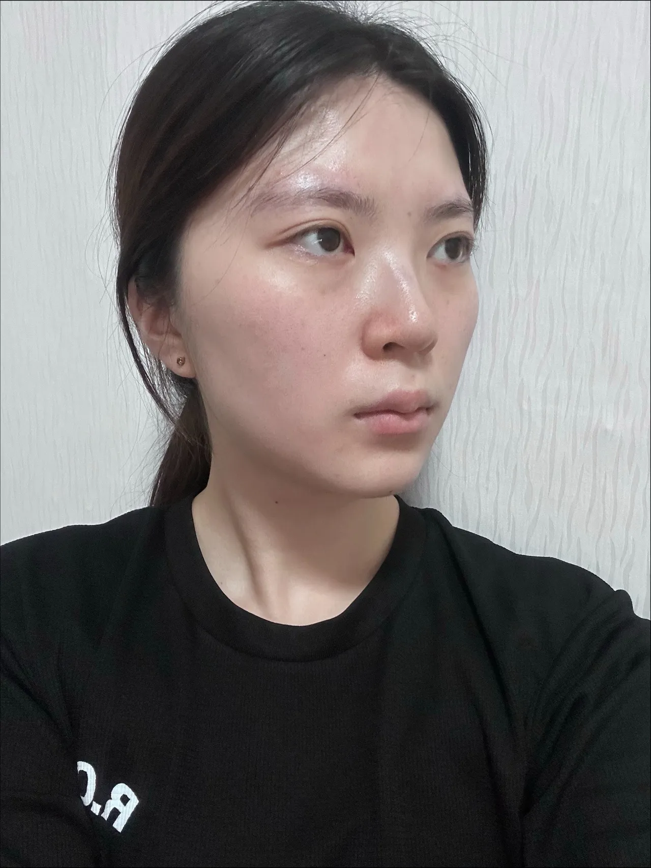 Chin Liposuction, Hump Nose, Low Bridge Nose — Luho Plastic Surgery 3