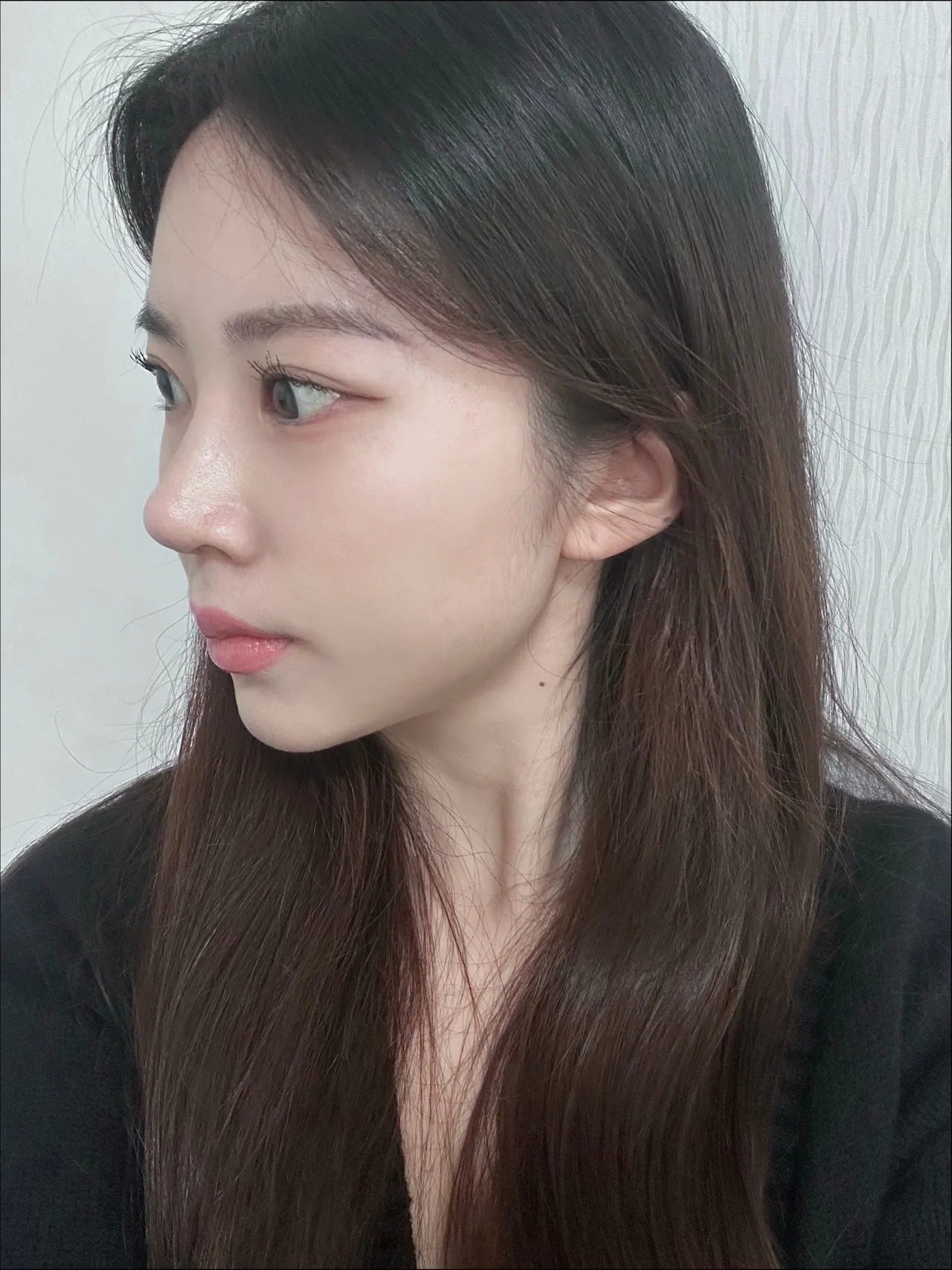 Chin Liposuction, Hump Nose, Low Bridge Nose — Luho Plastic Surgery 5