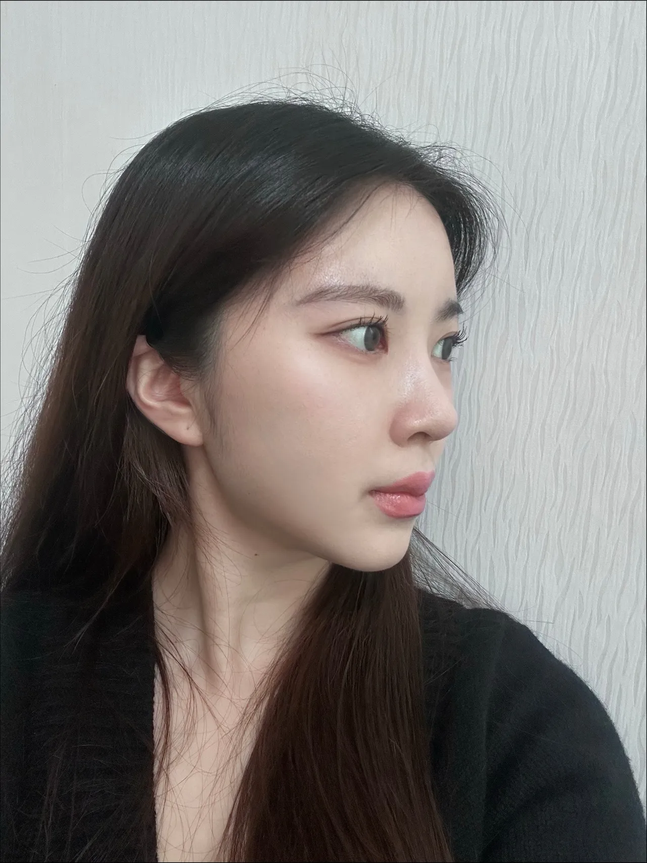 Chin Liposuction, Hump Nose, Low Bridge Nose — Luho Plastic Surgery 6