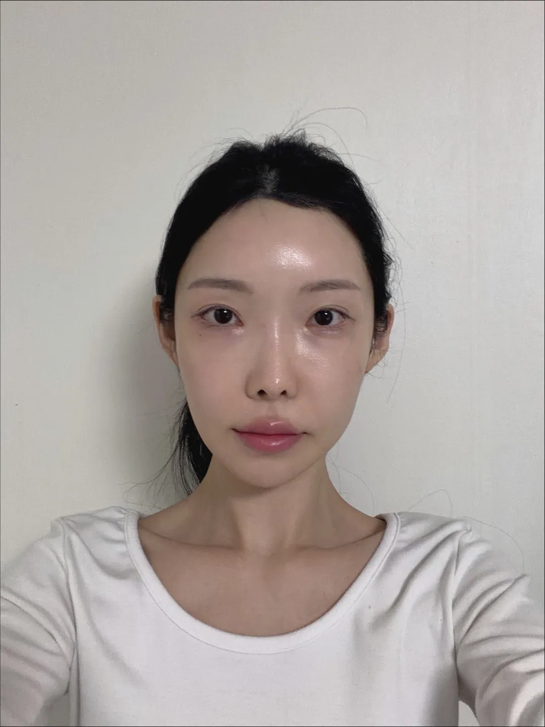 Rhinoplasty Revision 1