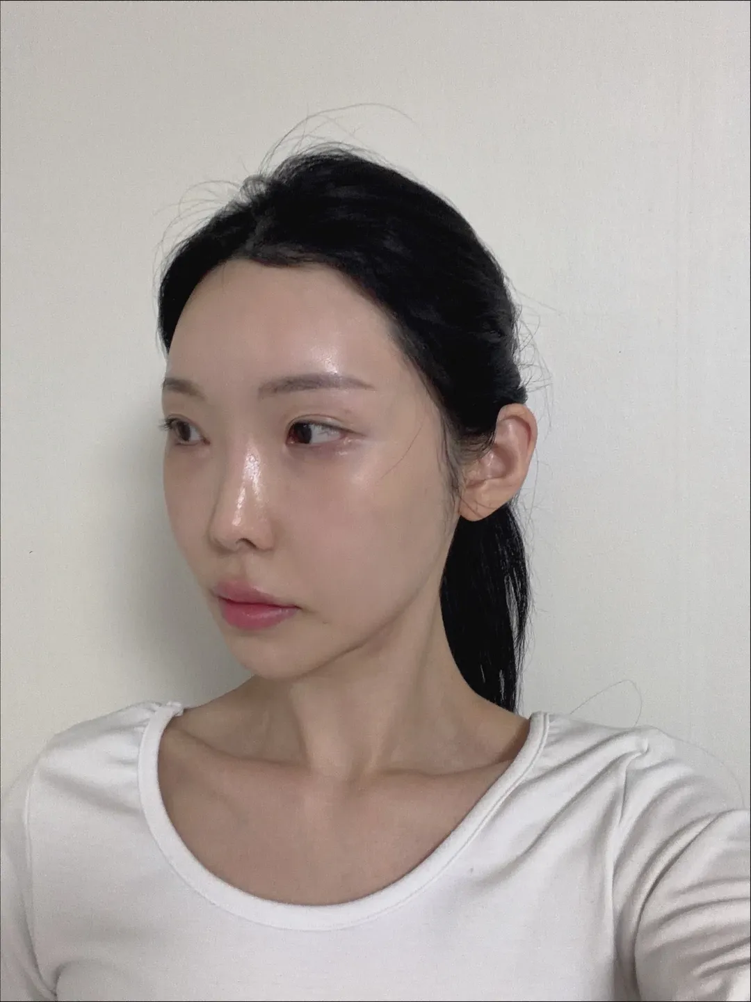 Rhinoplasty Revision 2