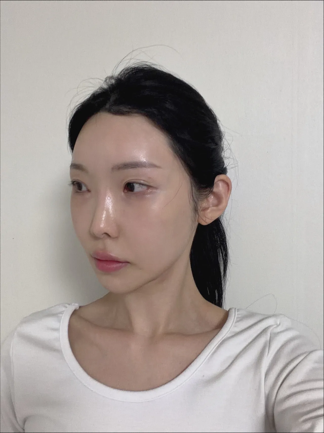 Rhinoplasty Revision — Luho Plastic Surgery 2
