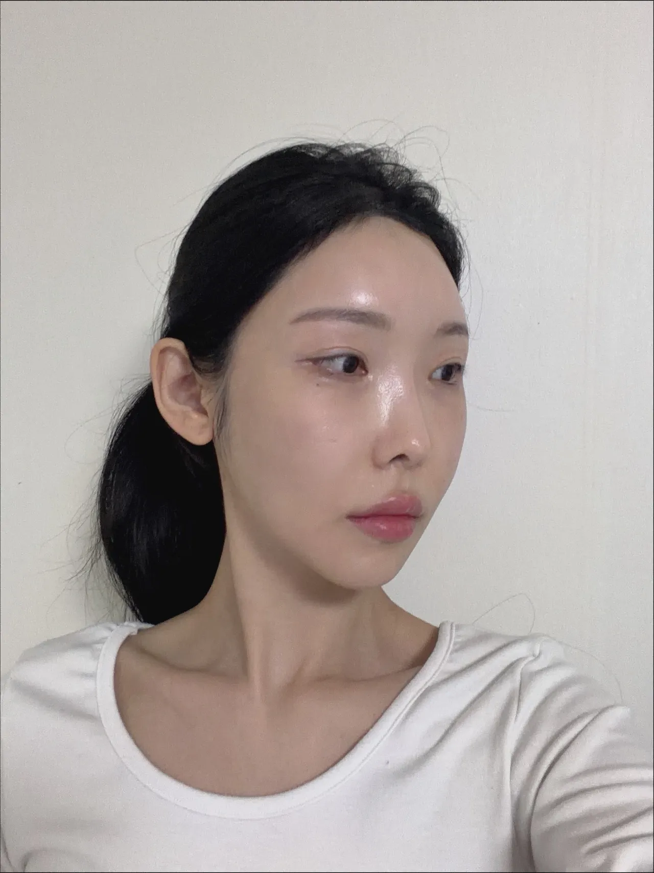 Rhinoplasty Revision — Luho Plastic Surgery 3