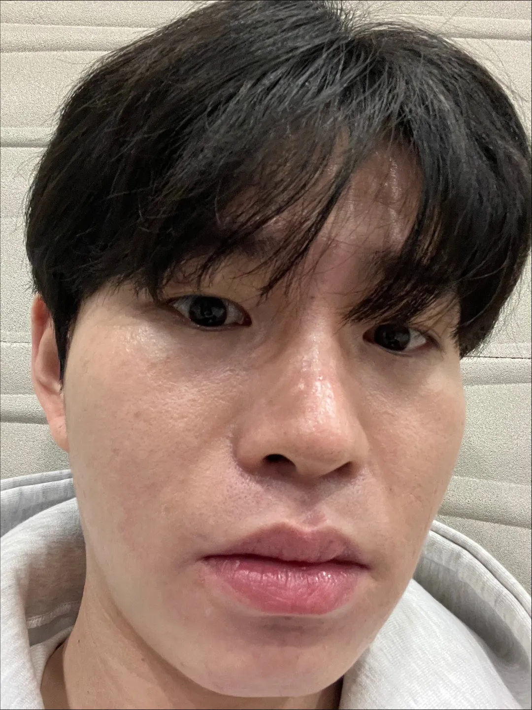 Natural Adhesion Double Eyelid Surgery, Ptosis Correction, Men’s eye surgery 1