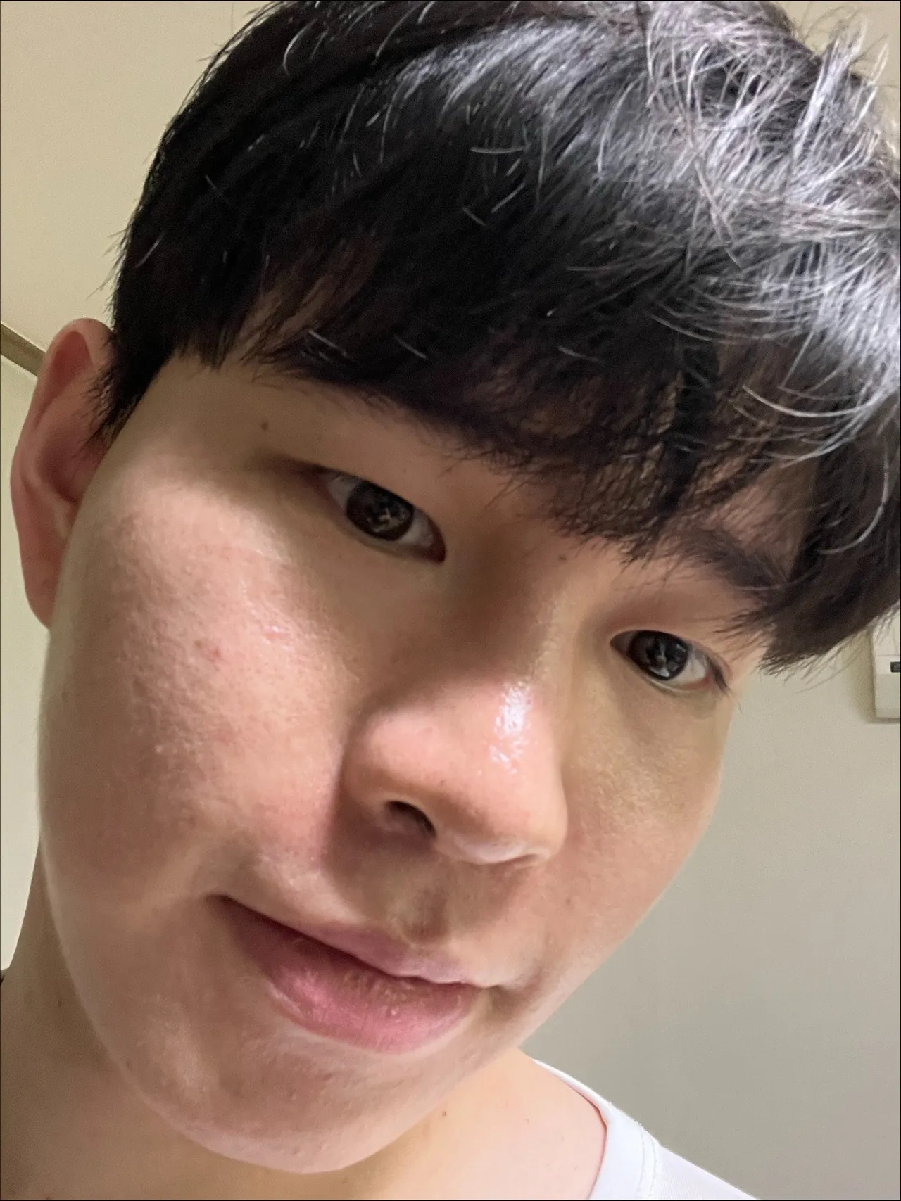 Natural Adhesion Double Eyelid Surgery, Ptosis Correction, Men’s eye surgery — Luho Plastic Surgery 2