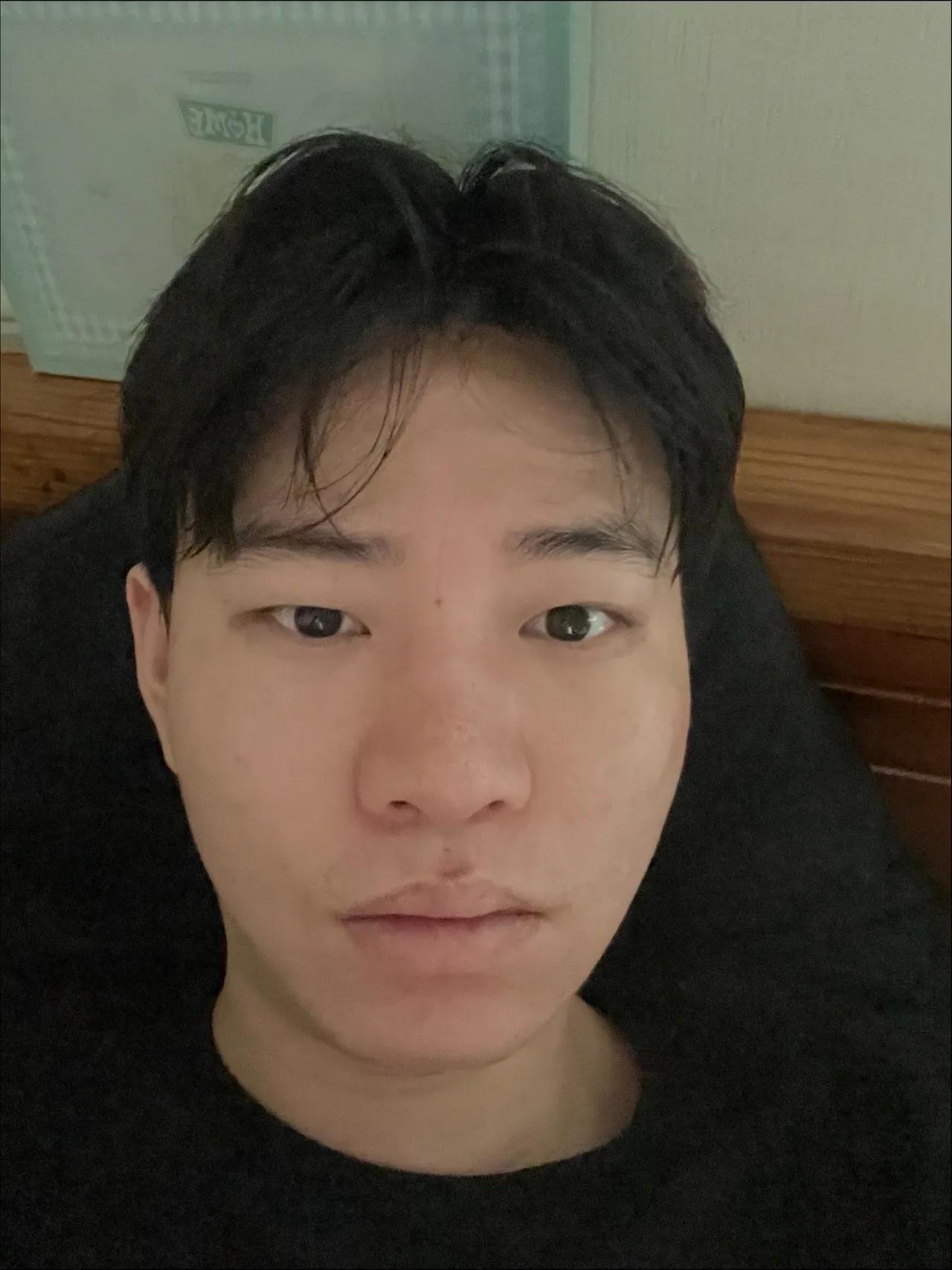 Natural Adhesion Double Eyelid Surgery, Ptosis Correction, Men’s eye surgery — Luho Plastic Surgery 3