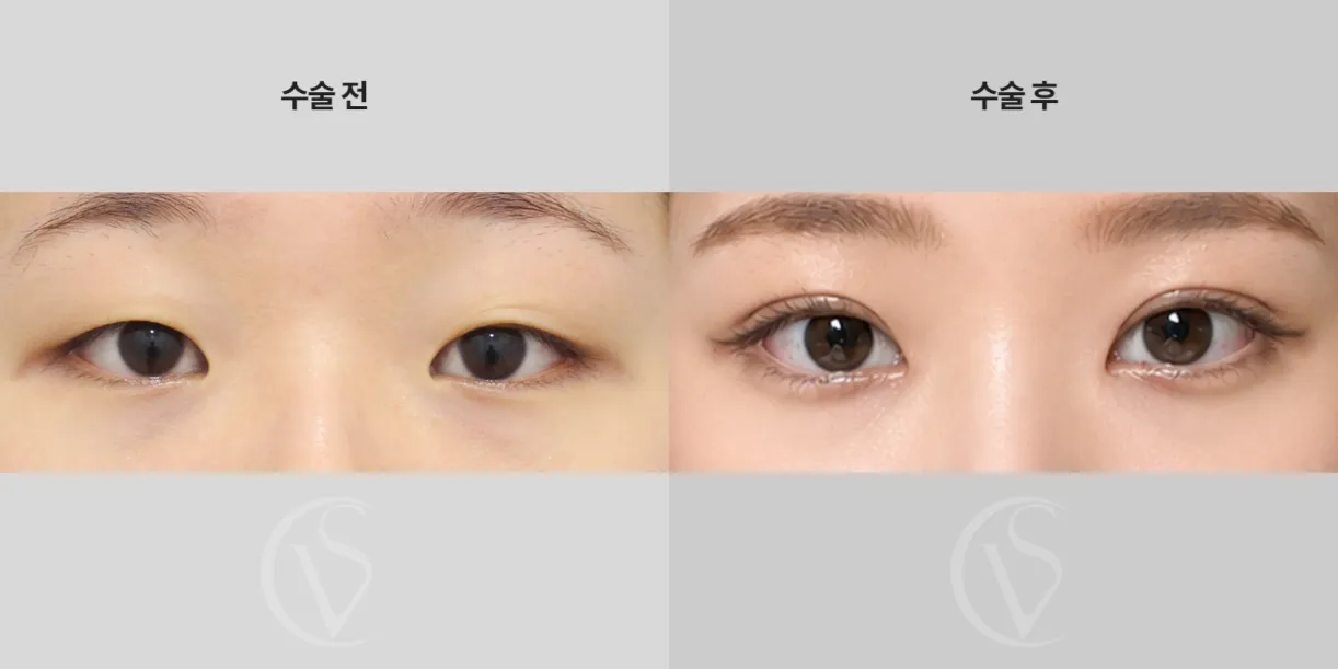 DOY JUN Plastic Surgery 2