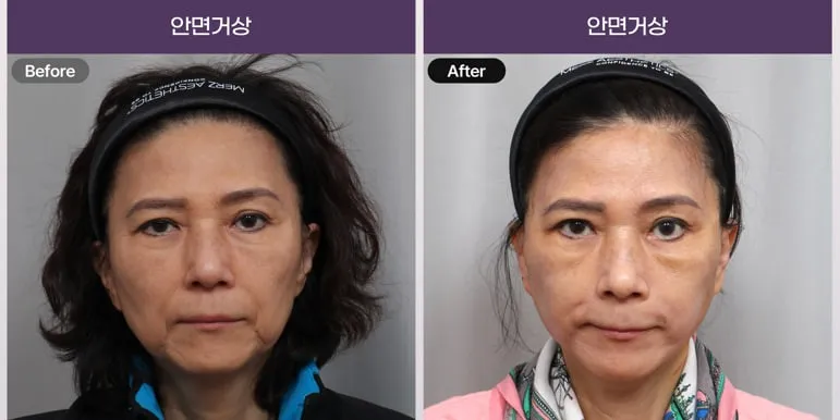 DOY JUN Plastic Surgery 4